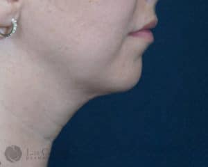 After Image: 6257 – Kybella
