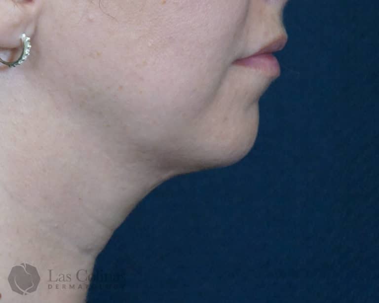 After Image: 6257 – Kybella - right-side