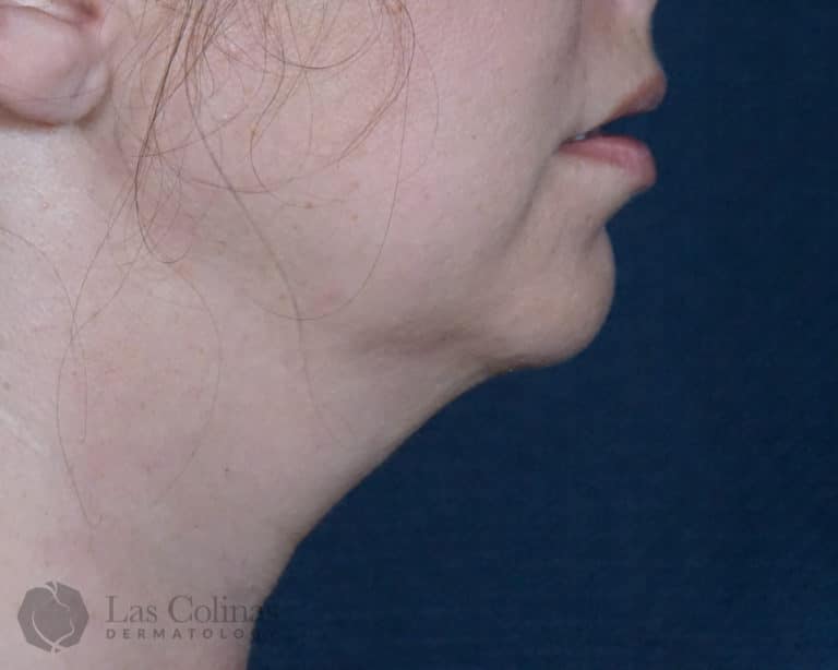 Before Image: 6257 – Kybella - right-side