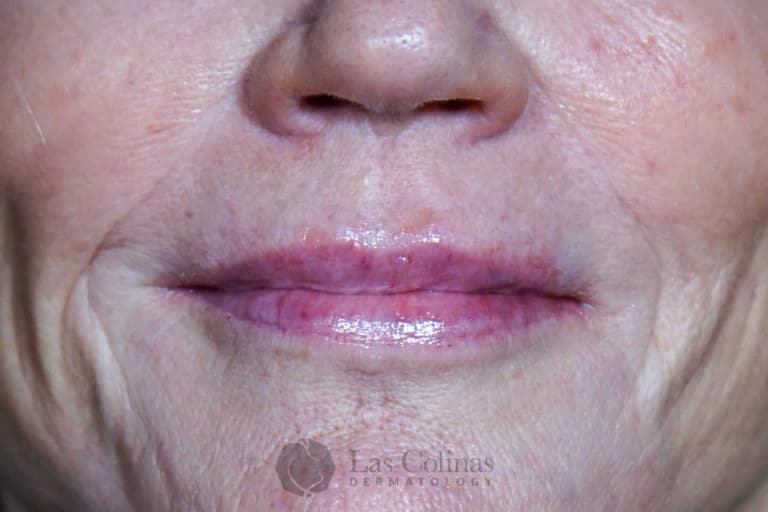 After Image: 6116 – Restylane Refyne - front