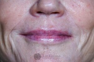 After Image: 6116 – Restylane Refyne