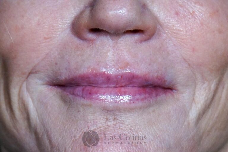 After Image: 6116 – Restylane Refyne - front
