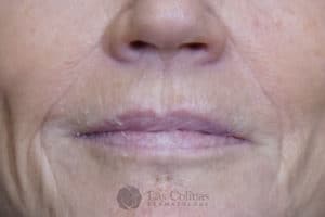 Before Image: 6116 – Restylane Refyne