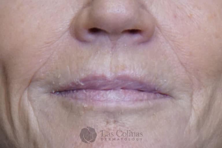 Before Image: 6116 – Restylane Refyne - front