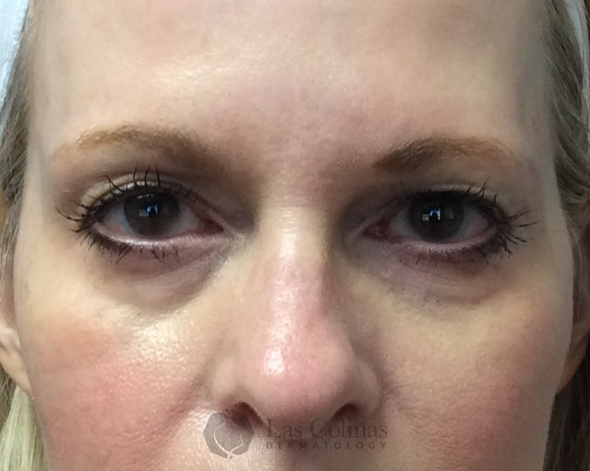 After Image: 7199 – Juvederm Voluma – Temples - front