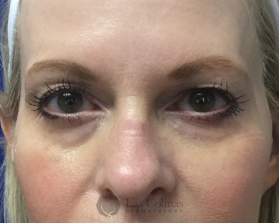 Before Image: 7199 – Juvederm Voluma – Temples - front