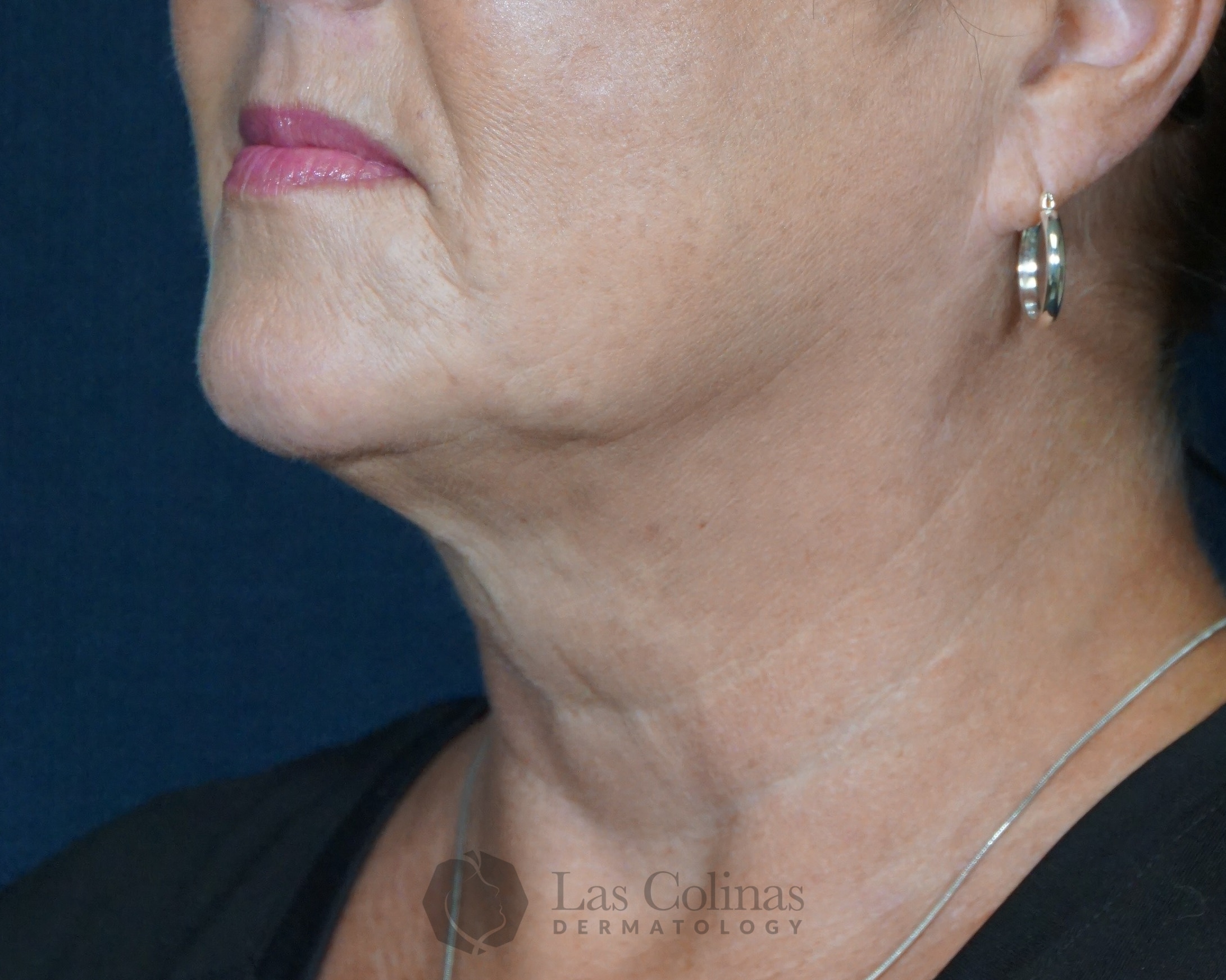 After Image: 27345 – Kybella - front
