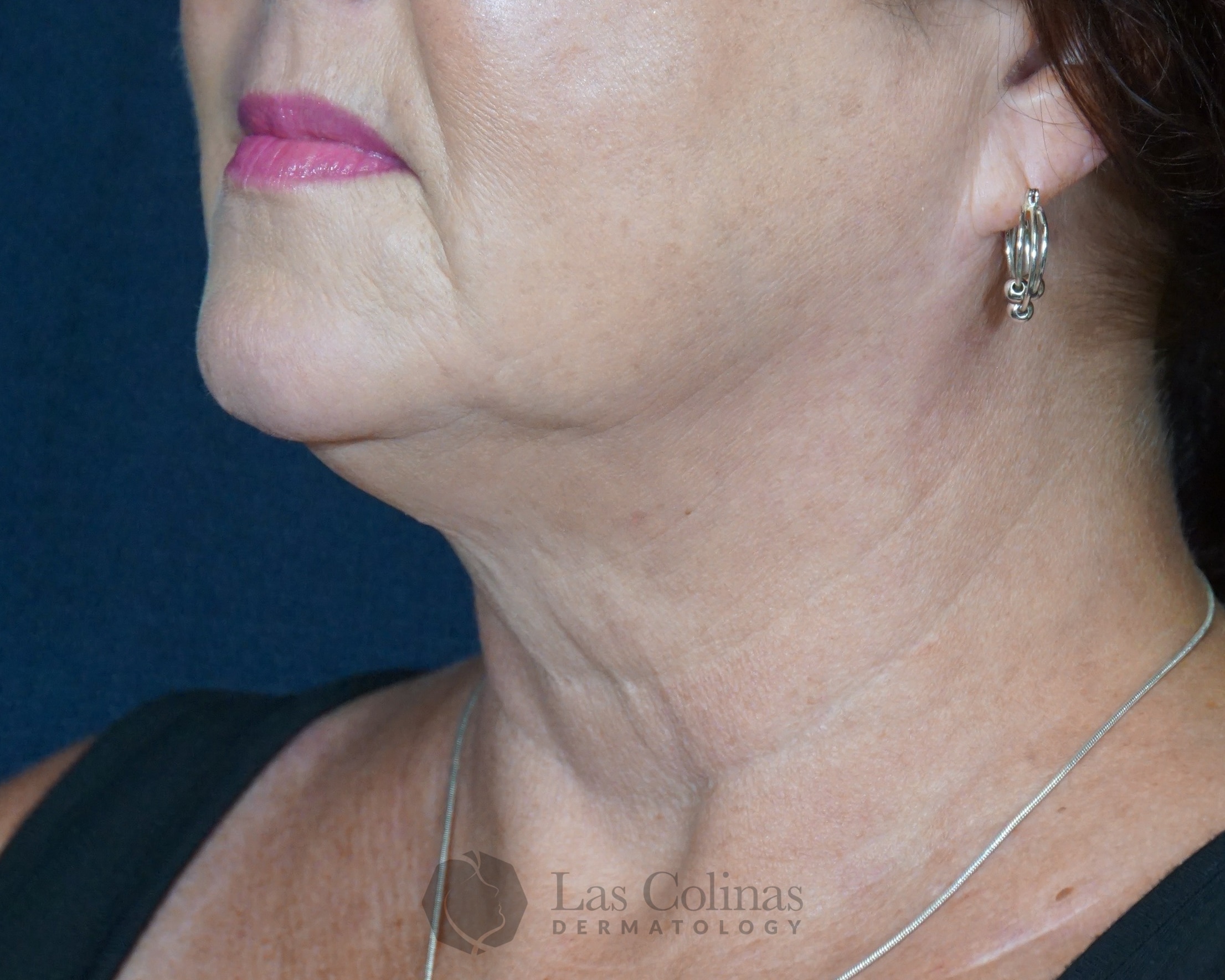 Before Image: 27345 – Kybella - front