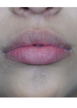 After Image: Juvederm Volbella – Lips – 18629 - front