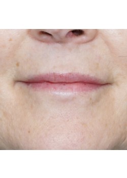 After Image: Juvederm Ultra -12194