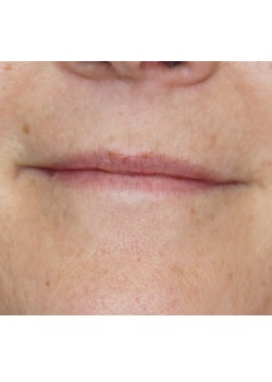 Before Image: Juvederm Ultra -12194