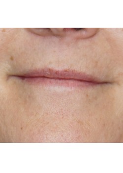 Juvederm Ultra -12194