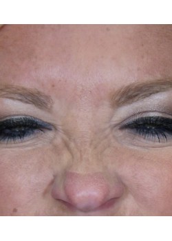 After Image: Botox – 1 - front