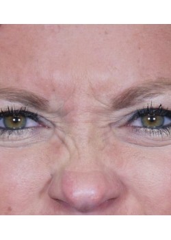 Before Image: Botox – 1 - front