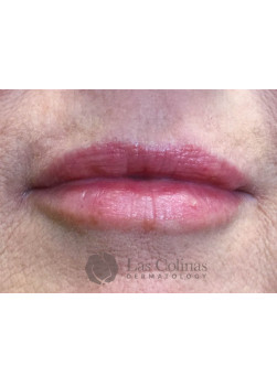 After Image: Restylane Kysse – 1 - front