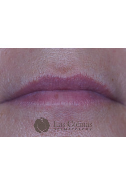 Before Image: Restylane Kysse – 2 - front