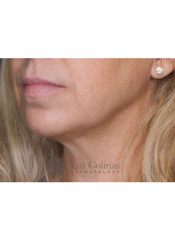 Kybella – 15988