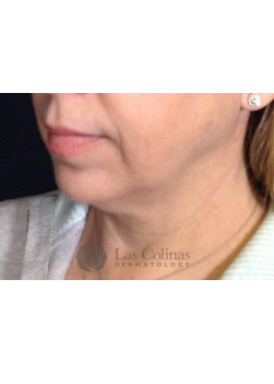 Before Image: Kybella – 15988 - other