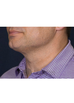 After Image: Kybella – 17684 - left-side