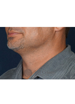 Before Image: Kybella – 17684 - left-side