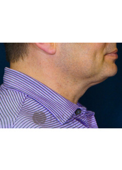 After Image: Kybella – 17684 - right-side