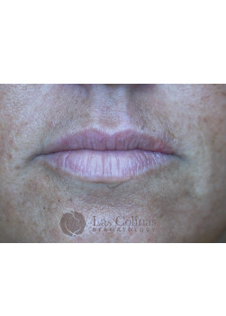 After Image: Restylane Kysse – 3 - front