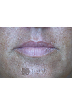 Before Image: Restylane Kysse – 3 - front