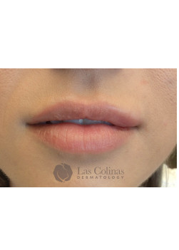After Image: Restylane Kysse – 4 - front