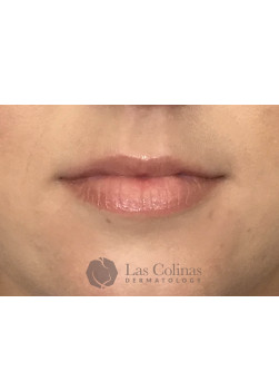 Before Image: Restylane Kysse – 4 - front