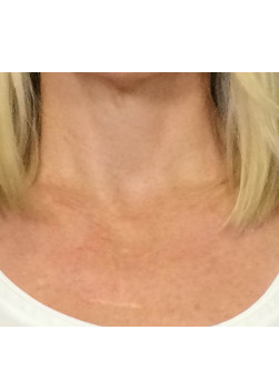 After Image: Photofacial (IPL) – Chest – 23237 - front