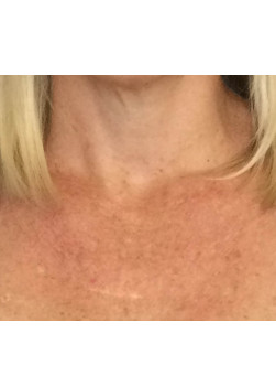 Before Image: Photofacial (IPL) – Chest – 23237 - front