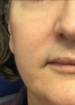 After Image: Juvederm Voluma – Upper Cheeks - front