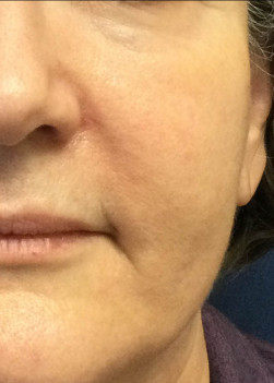 Before Image: Juvederm Voluma – Upper Cheeks - front