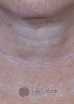 After Image: Restylane Refyne – Neck Lines - front