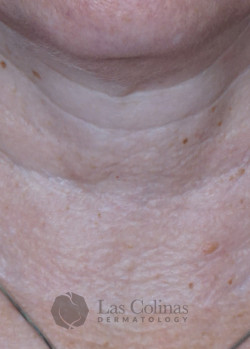Before Image: Restylane Refyne – Neck Lines - front