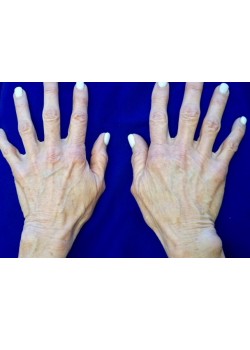 After Image: Photofacial Hands