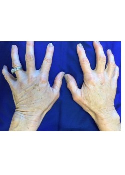 Before Image: Photofacial Hands