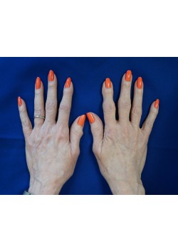 After Image: Voluma Hands