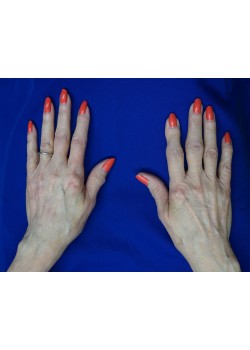 Before Image: Voluma Hands