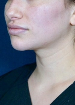 After Image: Kybella – 22246 - front