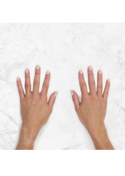 After Image: Restylane Lyft Hands -1