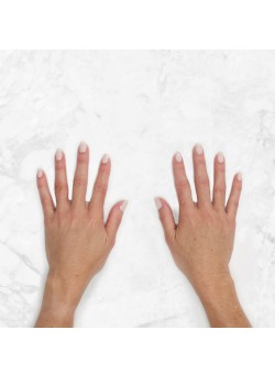 Restylane Lyft Hands -1