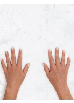 After Image: Restylane Lyft Hands -2
