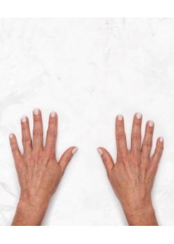 Before Image: Restylane Lyft Hands -2