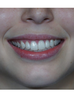 After Image: Botox – Gummy Smile - front