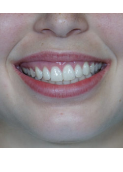Before Image: Botox – Gummy Smile - front