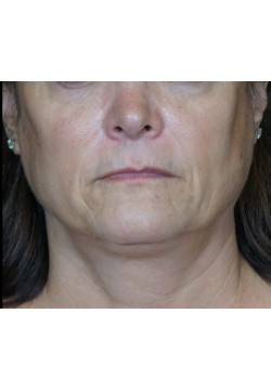 After Image: Juvederm Voluma – Upper Cheeks - front