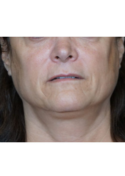 Before Image: Juvederm Voluma – Upper Cheeks - front