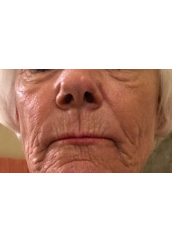 Before Image: Juvederm Voluma – Upper Cheeks - front