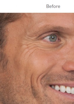 Before Image: Botox – 2 - other